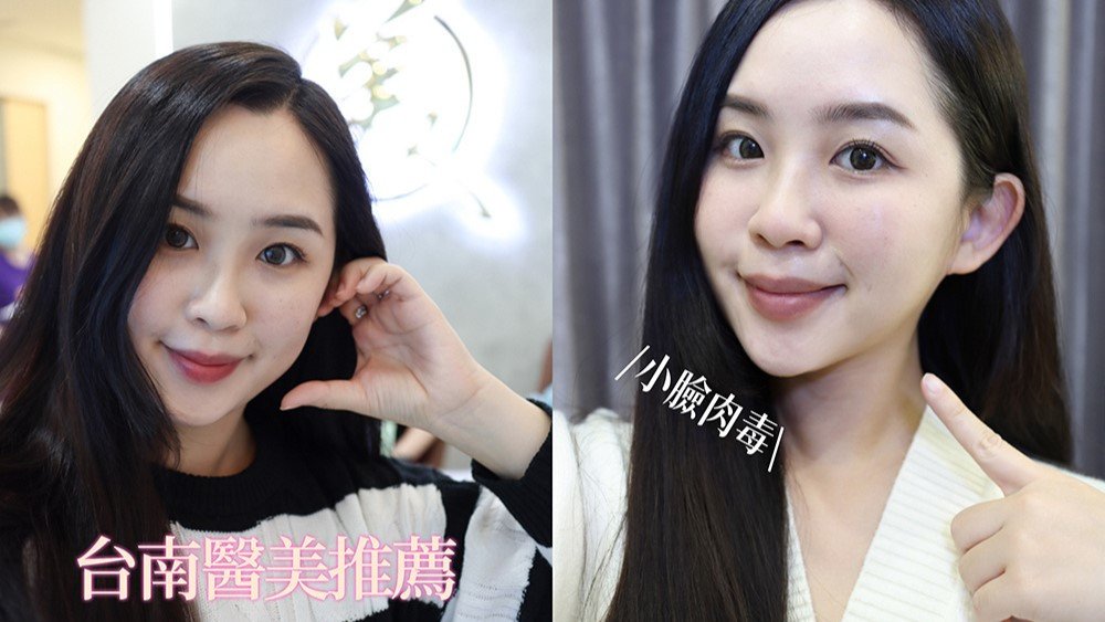 台南肉毒瘦小臉推薦｜美國肉毒Botox保妥適、咀嚼肌肉毒小臉